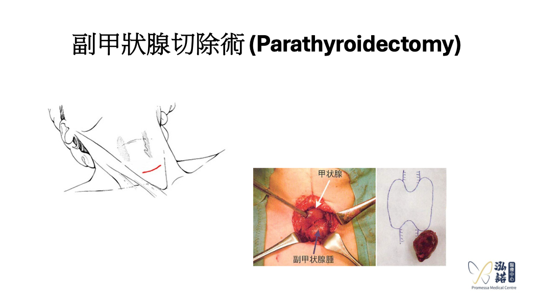 Parathyroidectomy